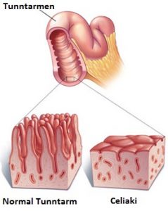 B12 brist Symtom Tr tthet Magproblem Och Neurologiska Sjukdomar b12-brist-symtom-tr-tthet-magproblem-och-neurologiska-sjukdomar