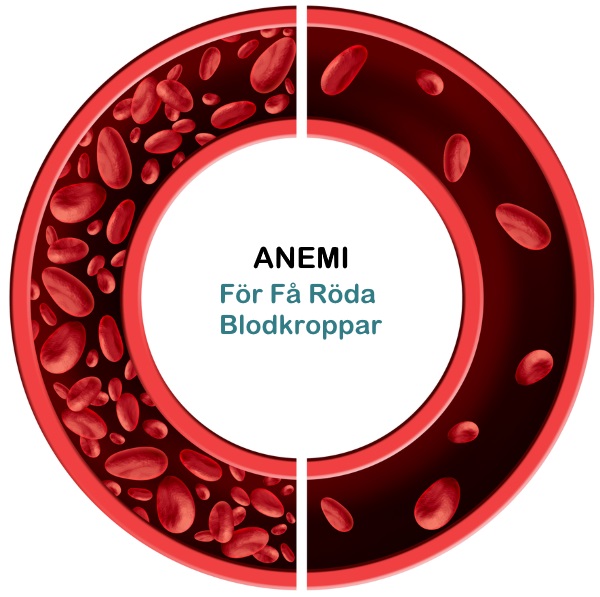 Roda-blodceller-anemi2